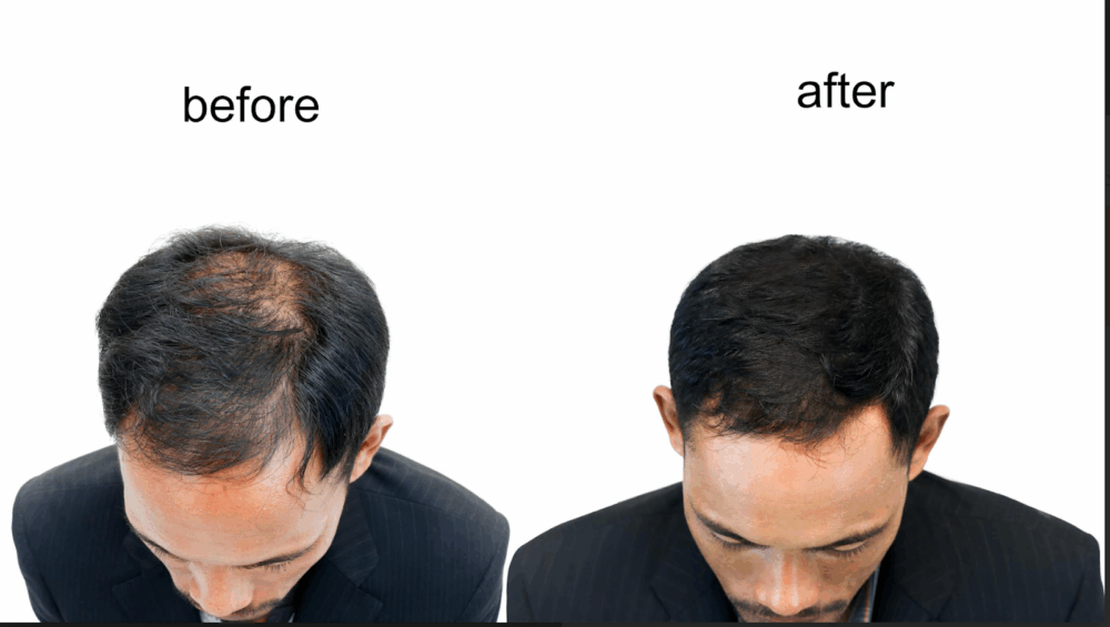 finasteride alternatives