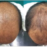 finasteride vs other treatments