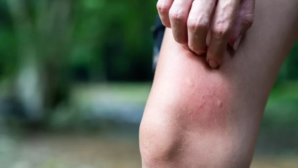 mounjaro skin sensitivity